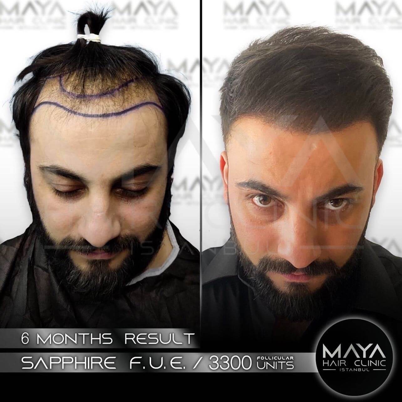 hair-transplant-maya-hair-clinic